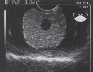 Ultrasound made with ultrasound prostate training phantom from CIRS, model 053S, 053L & 053L-EF